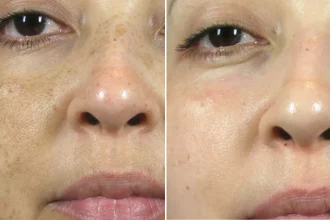 pigmentation kbb 1