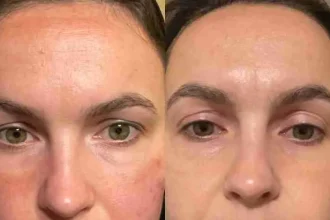 pigmentation kbb 2