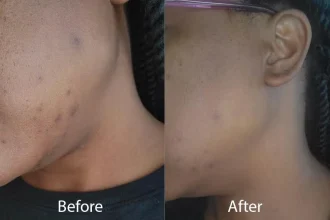 pigmentation-kbb-3