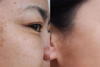 pigmentation-kbb-4